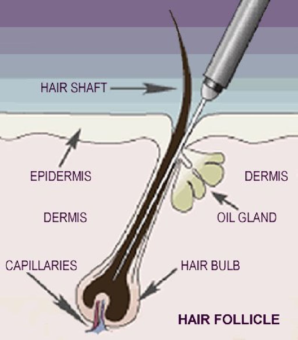 Electrolysis to shave a cunt