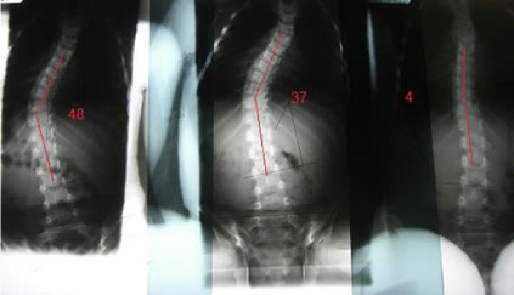 Scoliosis Correction Center - Treating Scoliosis Without Surgery