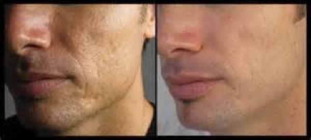 Permanent Makeup, Tattoo Removal Evansville, near Casino