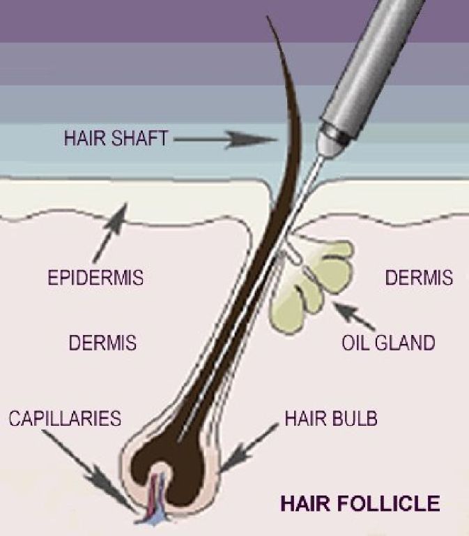 Permanent Hair Removal, Manscaping, Grooming for Men