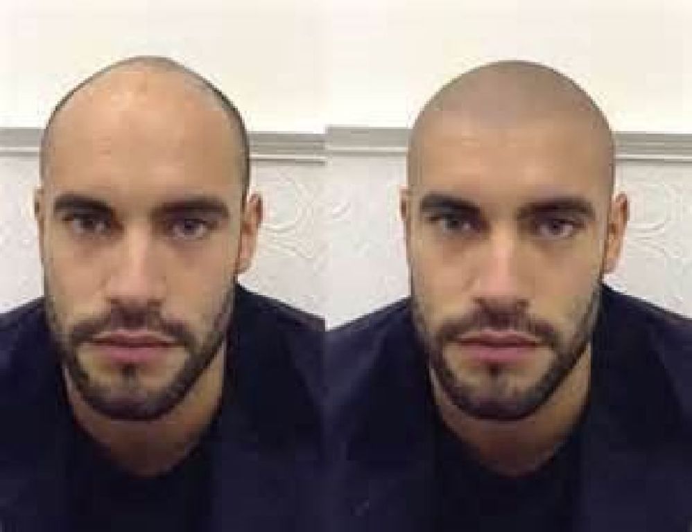 Permanent Makeup, Tattoo Removal Evansville, near Casino