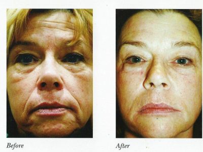 Natural Facial Looks with Wrinkles Laser Resurfacing