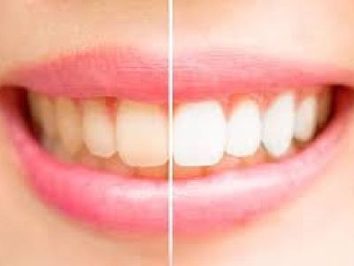 Find the Affordable Cosmetic Dentistry Services in Las Vegas