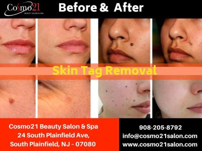 Best Skin Tag Removal in South Plainfield