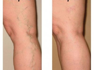 Procedure of Chicago Sclerotherapy Veins Treatment