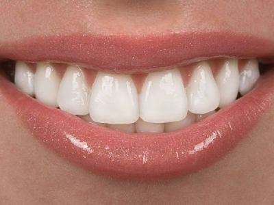 Improve Your Smile With Proclaim veneers - Sarasota Smile Design