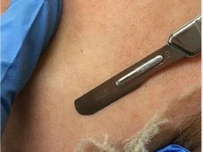 Facial hair removal for women
