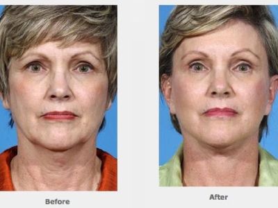 Face Lift Houston - Dr Ernest Layton