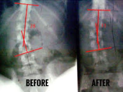 Know About Scoliosis Long Term Effects