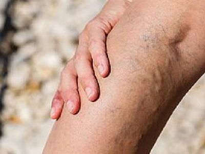 Vein Doctors of New York