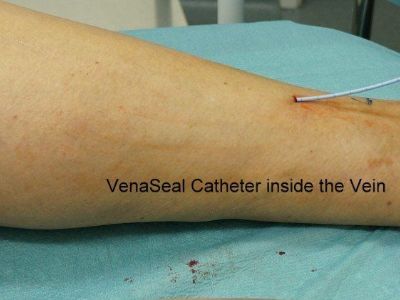 General Idea of Varicose Vein Laser Treatment Chicago