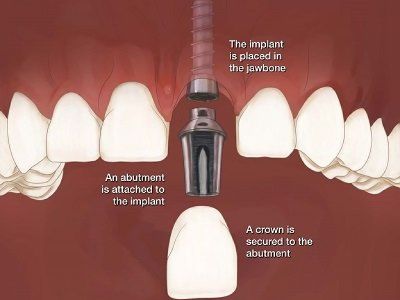 Smiles for Life Dental Care - Best Dental Implants & Dentures