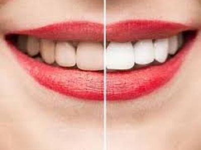 Get Pretty Smile with Teeth Whitening in Philadelphia