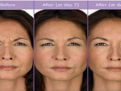 The Widespread Treatment of Facial Filler Chicago