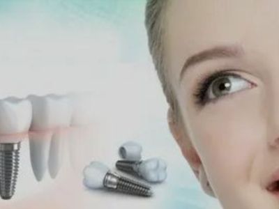 Tooth Replacement Wilmington :Restore Your Smile with Expert Dental Implants