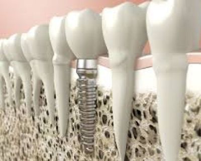 Replaced Damaged Teeth by Dental Implants Philadelphia