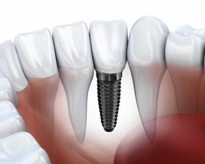 Add an Edge to Your Teeth with Cosmetic Dentist San Diego