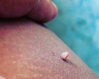 Skin tag removal 3/$50