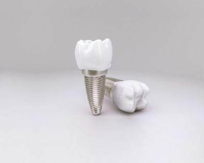 DENTAL IMPLANT | Dental Artistry Enhancing The Way You Smile