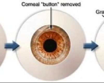 Corneal Disease Treatment & Transplant Surgery in Virgin Islands