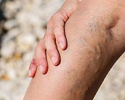 Contact
Address:  51 East 25th Street, Ste 431 New York, NY 10010
Phone:  212-389-1325
Website: 
http://www.varicoseveinscenternyc.com
About US
Find a vein doctor in NYC  like those at Manhattan Dermatology Specialists. They can diagnose the complex cause of your underlying vein issues. They are experts at providing treatments to achieve the symptom relief and cosmesis you desire. Regardless of...