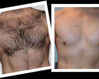Hair Removal for both Men & Women . "Perfect YOU" Hair Removal
