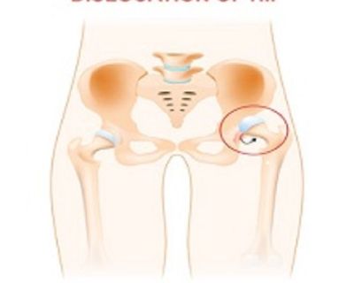 Looking  for a Hip Surgeon in Texas? Schedule an appointment through THSOC!